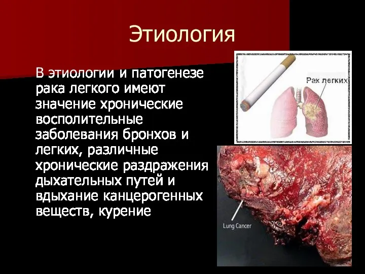 Этиология В этиологии и патогенезе рака легкого имеют значение хронические восполительные