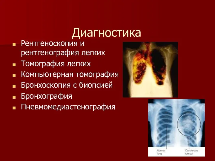 Диагностика Рентгеноскопия и рентгенография легких Томография легких Компьютерная томография Бронхоскопия с биопсией Бронхография Пневмомедиастенография