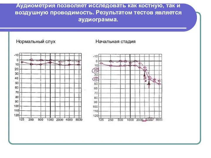 Аудиометрия позволяет исследовать как костную, так и воздушную проводимость. Результатом тестов