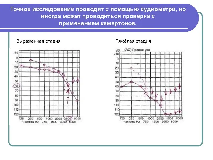 Точное исследование проводят с помощью аудиометра, но иногда может проводиться проверка