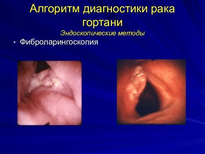 Алгоритм диагностики рака гортани Эндоскопические методы Фиброларингоскопия