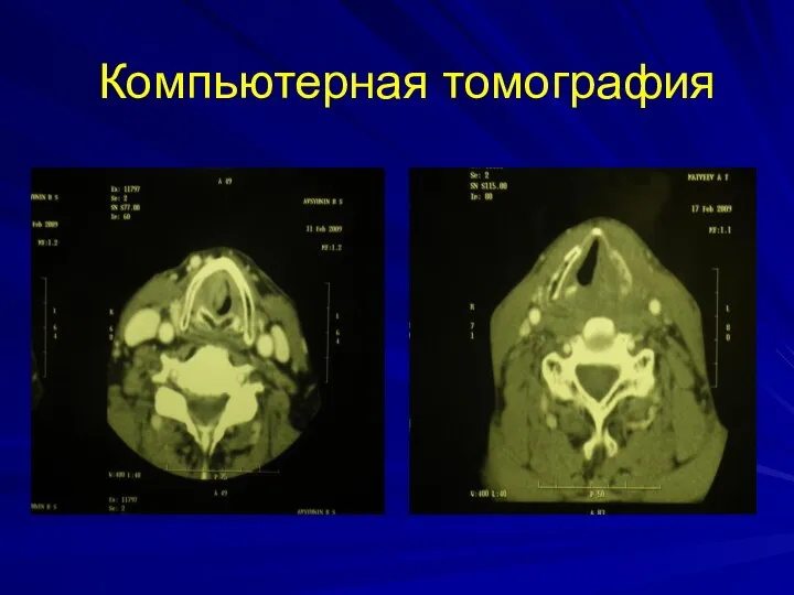 Компьютерная томография