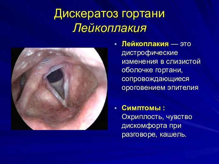 Дискератоз гортани Лейкоплакия Лейкоплакия — это дистрофические изменения в слизистой оболочке