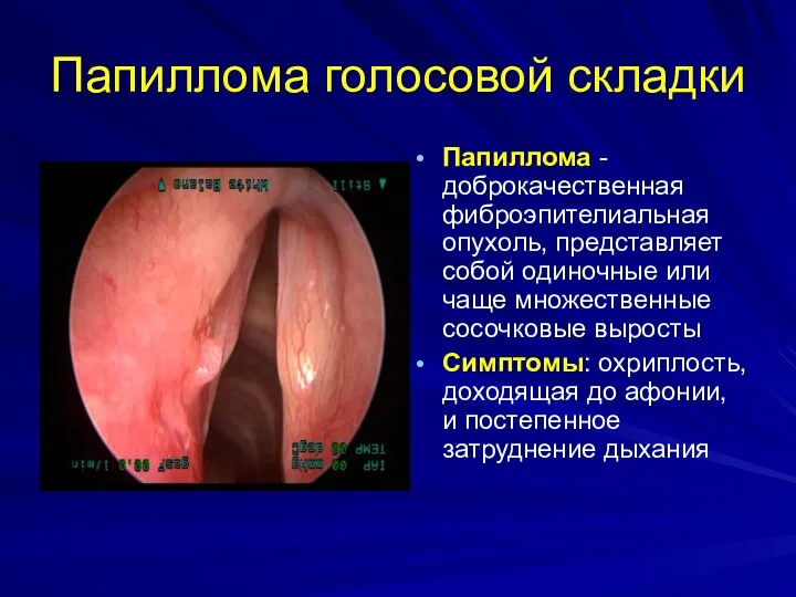 Папиллома голосовой складки Папиллома - доброкачественная фиброэпителиальная опухоль, представляет собой одиночные