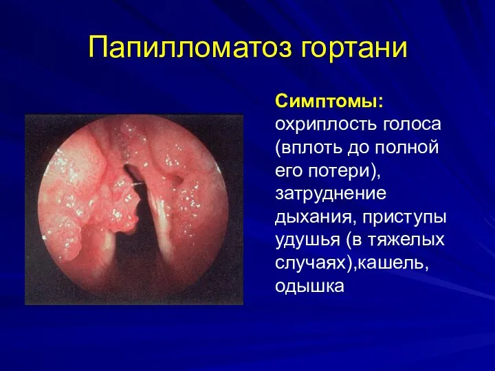 Папилломатоз гортани Симптомы: охриплость голоса (вплоть до полной его потери), затруднение