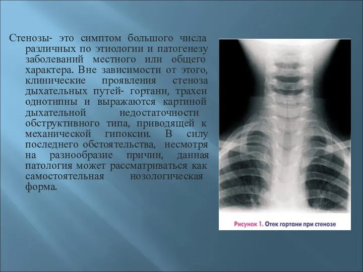 Стенозы- это симптом большого числа различных по этиологии и патогенезу заболеваний