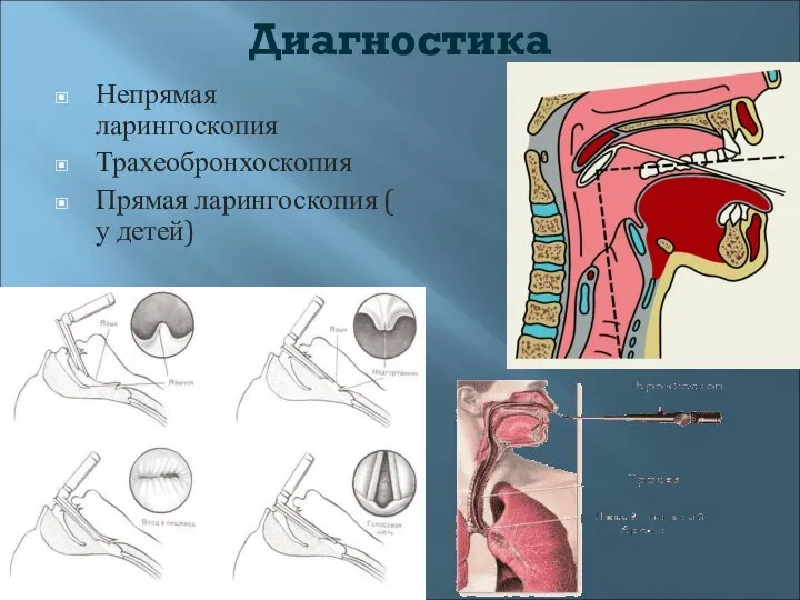 Диагностика Непрямая ларингоскопия Трахеобронхоскопия Прямая ларингоскопия ( у детей)