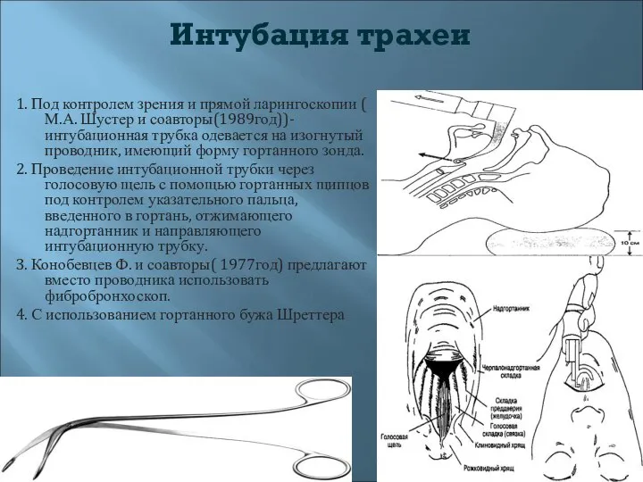 Интубация трахеи 1. Под контролем зрения и прямой ларингоскопии ( М.А.