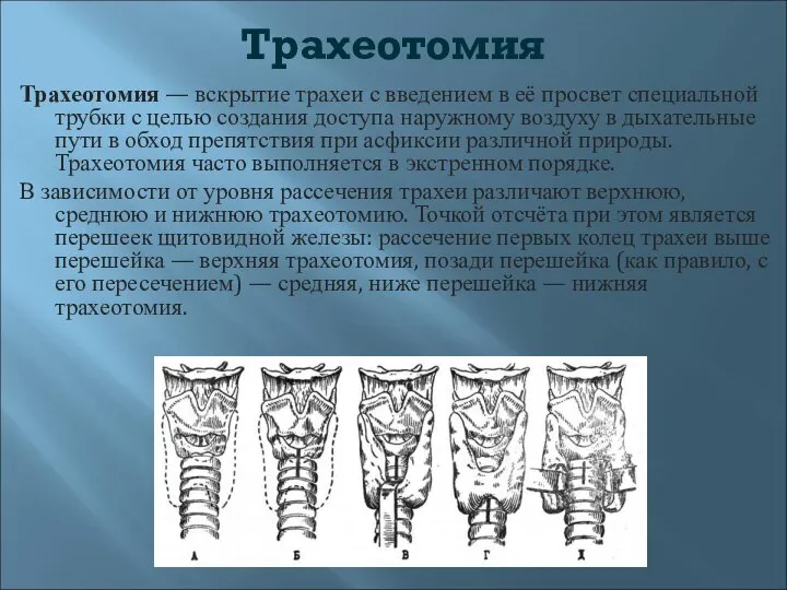 Трахеотомия Трахеотомия — вскрытие трахеи с введением в её просвет специальной