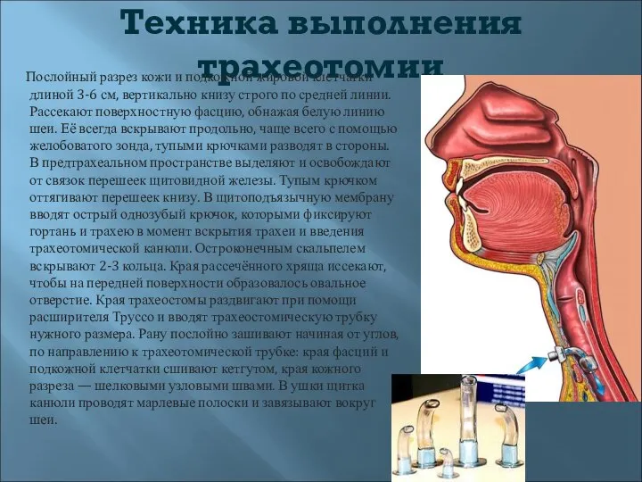 Техника выполнения трахеотомии Послойный разрез кожи и подкожной жировой клетчатки длиной