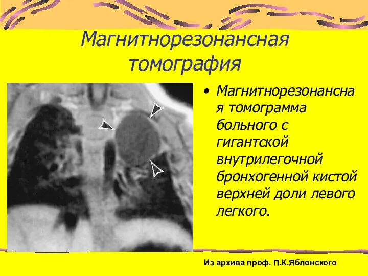 Магнитнорезонансная томография Магнитнорезонансная томограмма больного с гигантской внутрилегочной бронхогенной кистой верхней