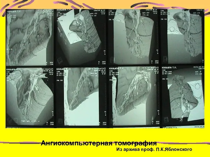 Ангиокомпьютерная томография Из архива проф. П.К.Яблонского