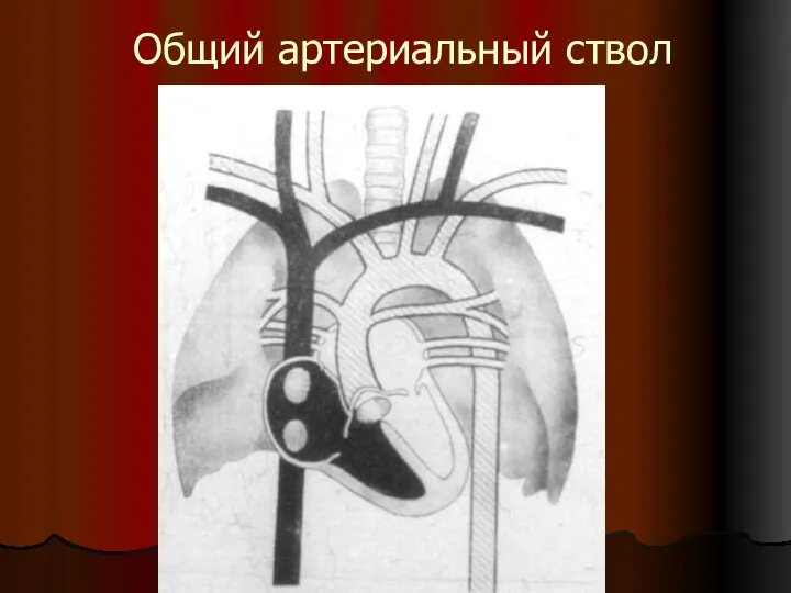 Общий артериальный ствол