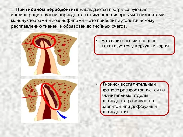 При гнойном периодонтите наблюдается прогрессирующая инфильтрация тканей периодонта полиморфно-ядерными лейкоцитами, мононуклеарами