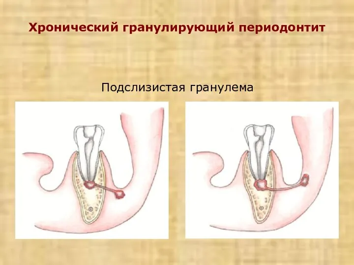 Хронический гранулирующий периодонтит Подслизистая гранулема