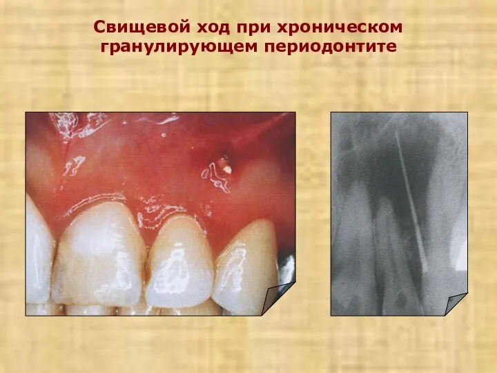 Свищевой ход при хроническом гранулирующем периодонтите