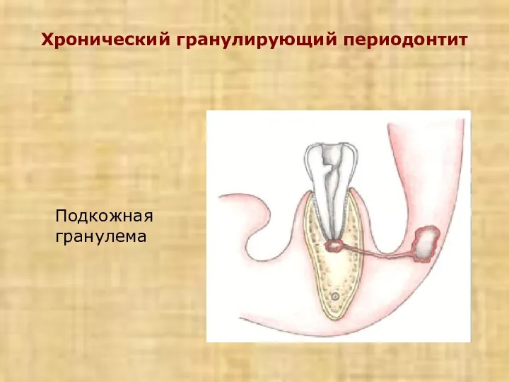 Хронический гранулирующий периодонтит Подкожная гранулема