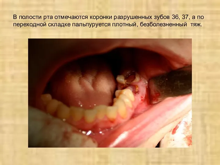 В полости рта отмечаются коронки разрушенных зубов 36, 37, а по