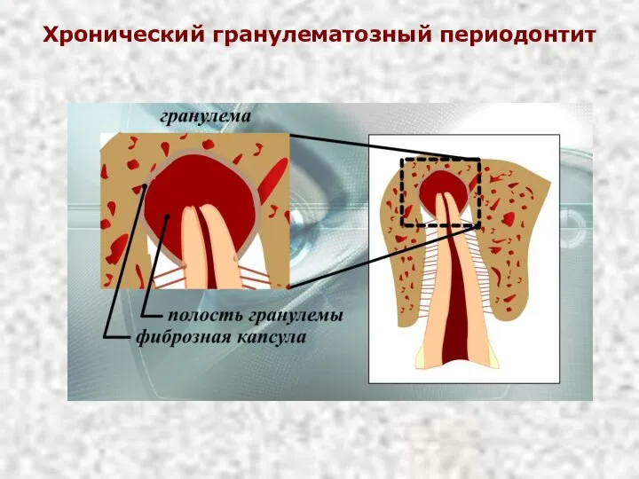 Хронический гранулематозный периодонтит