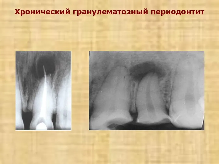 Хронический гранулематозный периодонтит