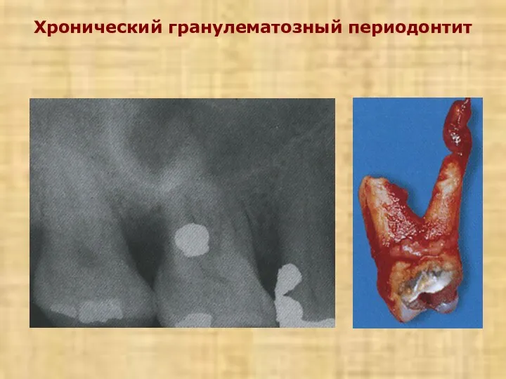 Хронический гранулематозный периодонтит