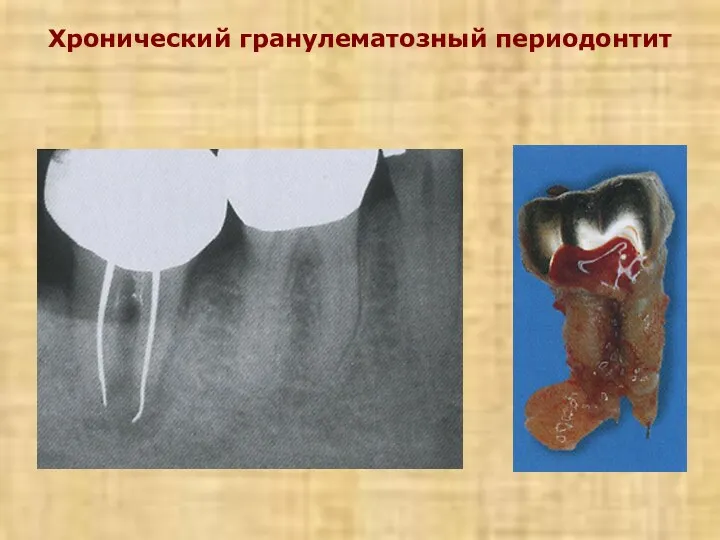 Хронический гранулематозный периодонтит