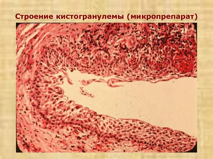 Строение кистогранулемы (микропрепарат)