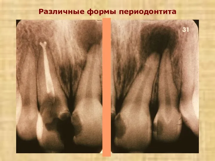 Различные формы периодонтита