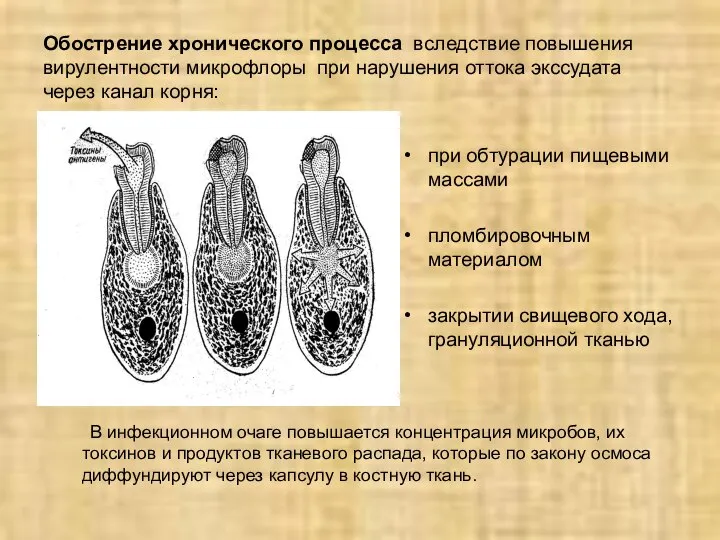 Обострение хронического процесса вследствие повышения вирулентности микрофлоры при нарушения оттока экссудата