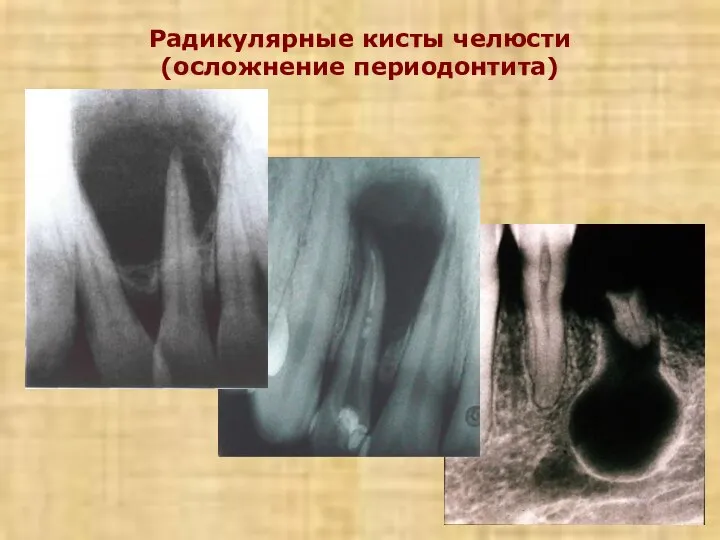 Радикулярные кисты челюсти (осложнение периодонтита)