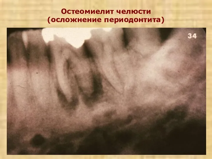 Остеомиелит челюсти (осложнение периодонтита)