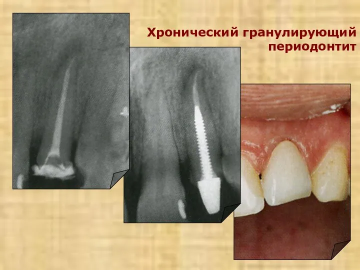 Хронический гранулирующий периодонтит