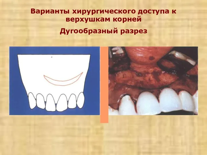 Варианты хирургического доступа к верхушкам корней Дугообразный разрез