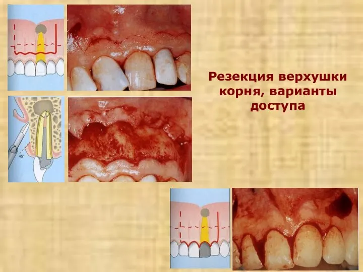 Резекция верхушки корня, варианты доступа