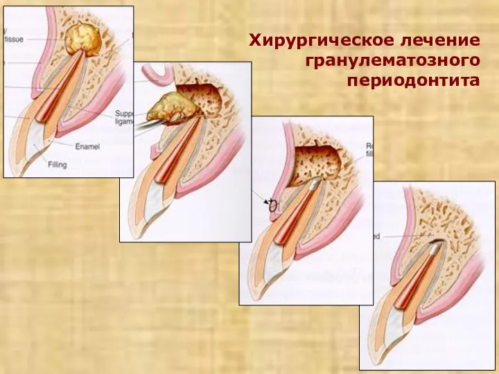 Хирургическое лечение гранулематозного периодонтита