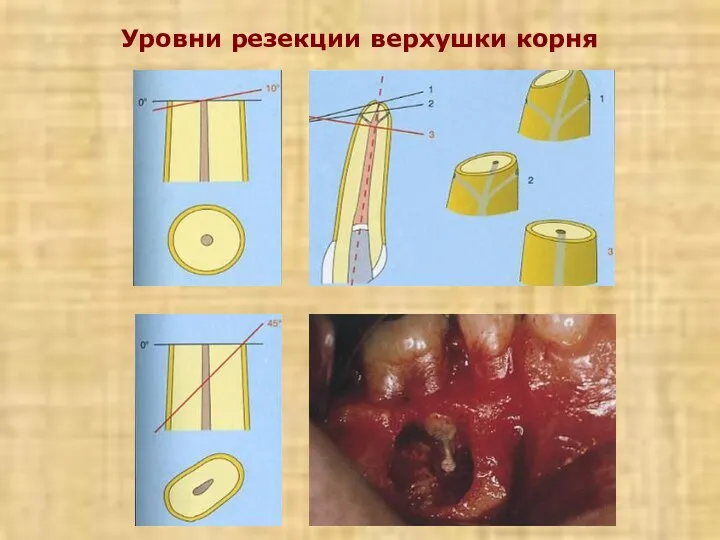 Уровни резекции верхушки корня