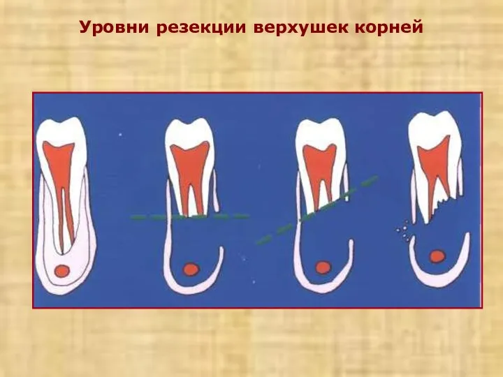 Уровни резекции верхушек корней