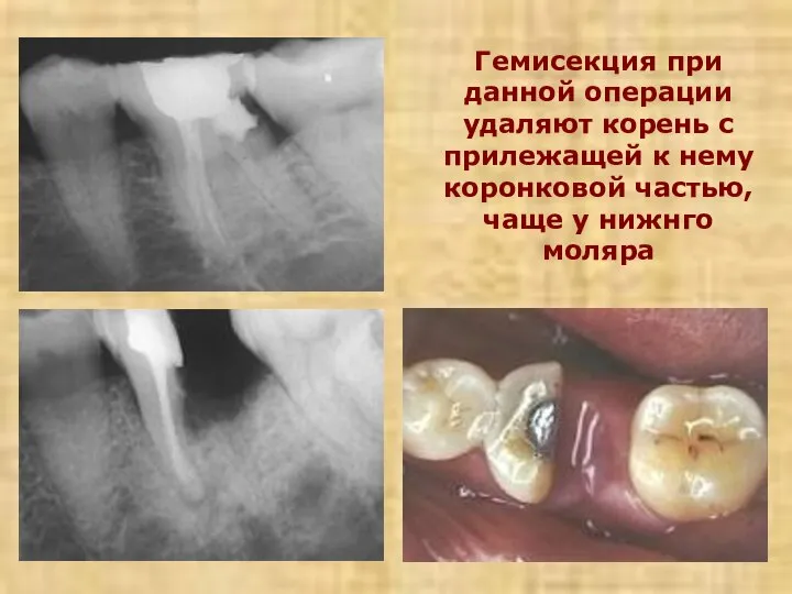 Гемисекция при данной операции удаляют корень с прилежащей к нему коронковой частью, чаще у нижнго моляра