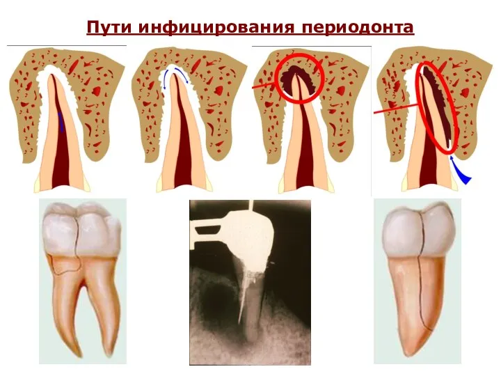 Пути инфицирования периодонта
