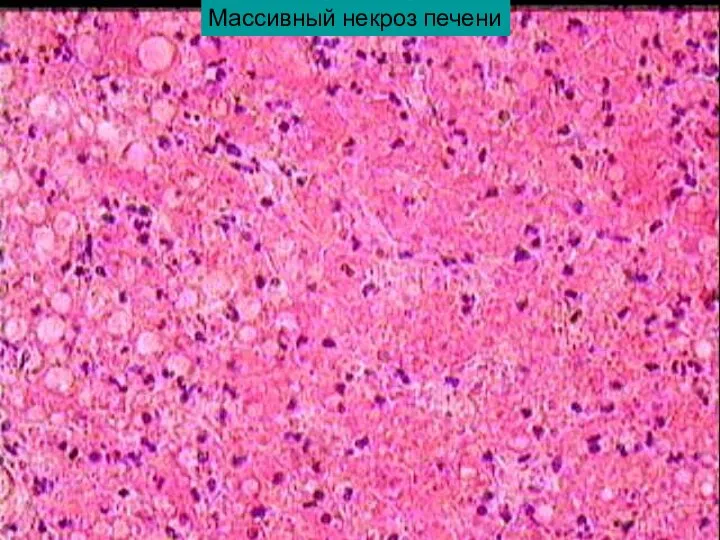 Массивный некроз печени