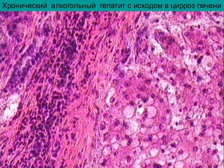 Хронический алкогольный гепатит с исходом в цирроз печени