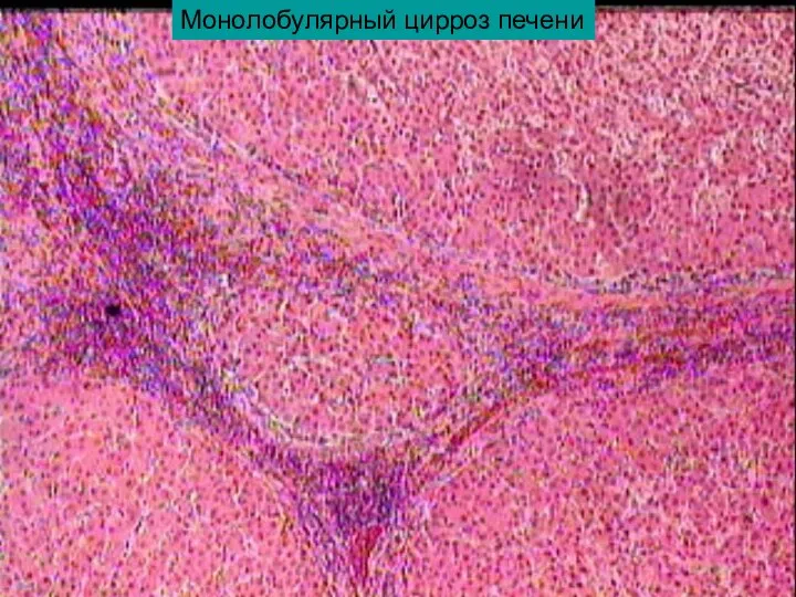 Монолобулярный цирроз печени