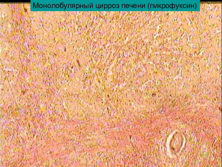 Монолобулярный цирроз печени (пикрофуксин)
