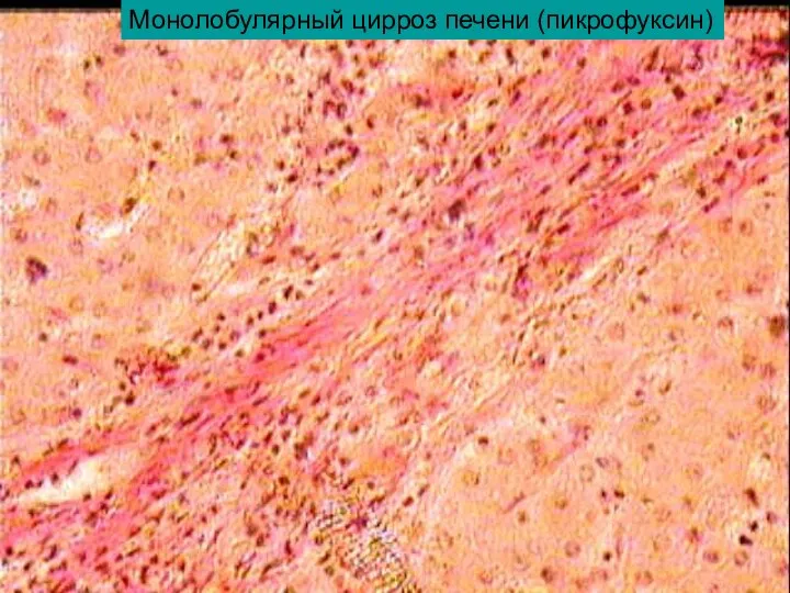 Монолобулярный цирроз печени (пикрофуксин)