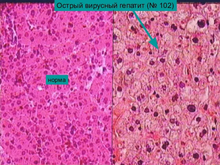 Острый вирусный гепатит (№ 102) норма