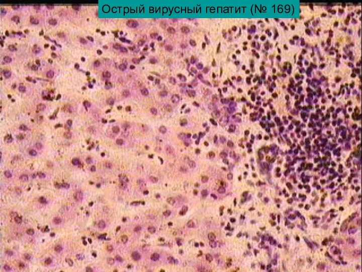 Острый вирусный гепатит (№ 169)