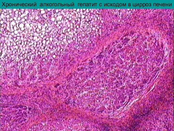 Хронический алкогольный гепатит с исходом в цирроз печени