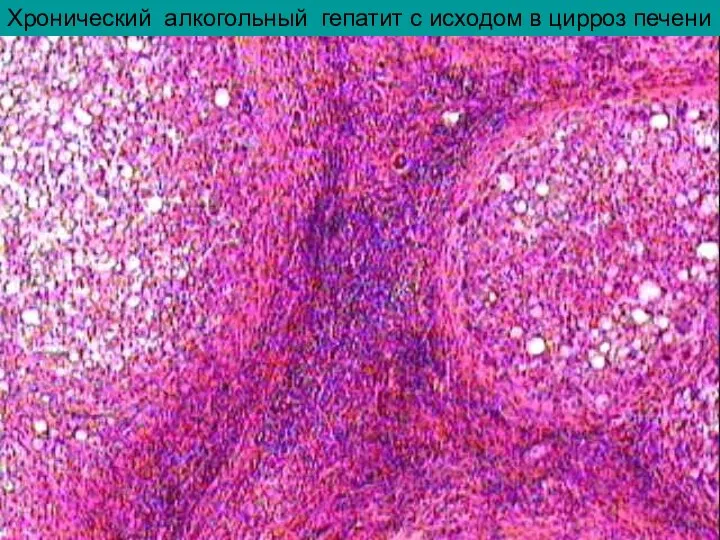 Хронический алкогольный гепатит с исходом в цирроз печени