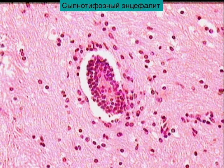 Сыпнотифозный энцефалит