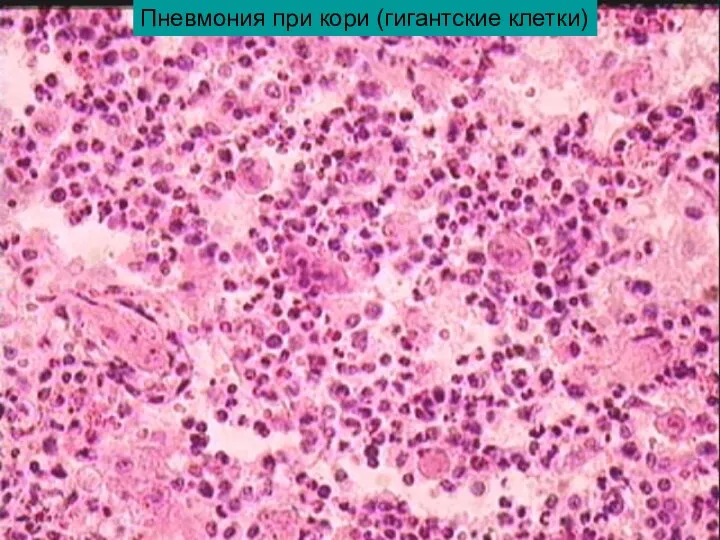 Пневмония при кори (гигантские клетки)